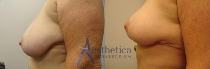 Breast Lift Case 335 Before & After View #3 | Columbus, OH | Aesthetica Surgery & Spa