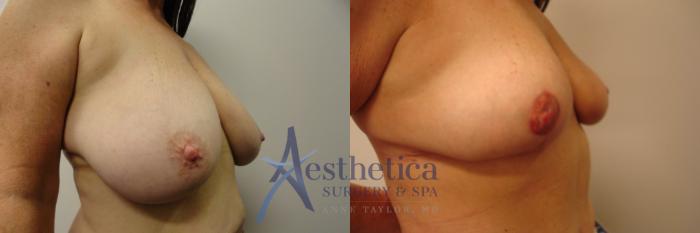 Breast Lift Case 335 Before & After View #4 | Columbus, OH | Aesthetica Surgery & Spa