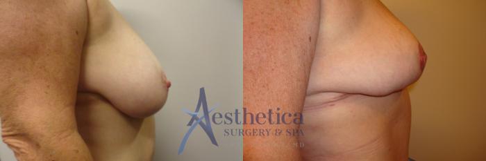 Breast Lift Case 335 Before & After View #5 | Columbus, OH | Aesthetica Surgery & Spa