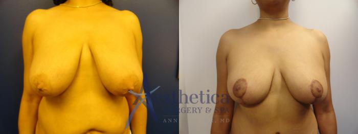 Breast Lift Case 336 Before & After View #1 | Columbus, OH | Aesthetica Surgery & Spa