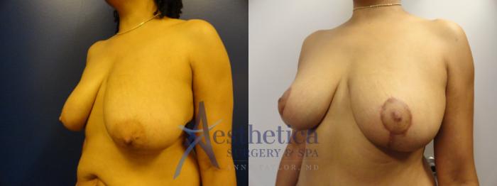 Breast Lift Case 336 Before & After View #2 | Columbus, OH | Aesthetica Surgery & Spa