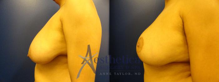 Breast Lift Case 336 Before & After View #3 | Columbus, OH | Aesthetica Surgery & Spa