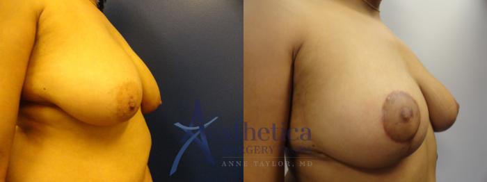Breast Lift Case 336 Before & After View #4 | Columbus, OH | Aesthetica Surgery & Spa