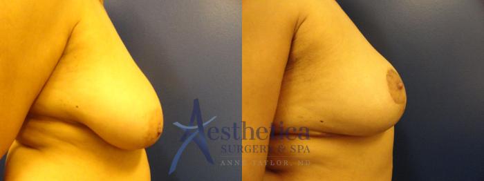 Breast Lift Case 336 Before & After View #5 | Columbus, OH | Aesthetica Surgery & Spa