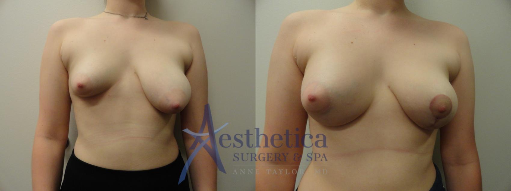 Breast Lift Case 346 Before & After View #1 | Columbus, OH | Aesthetica Surgery & Spa