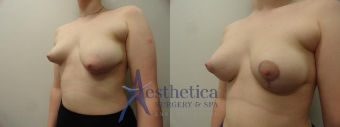 Breast Lift Case 346 Before & After View #2 | Columbus, OH | Aesthetica Surgery & Spa