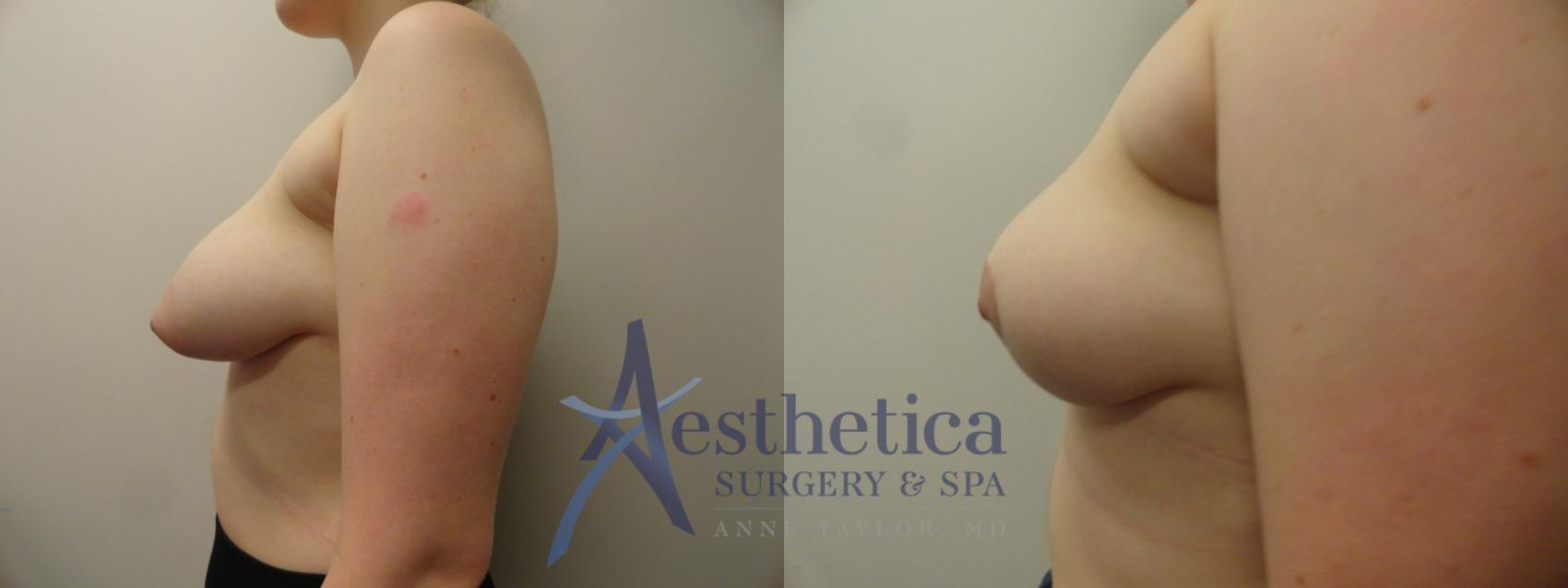 Breast Lift Case 346 Before & After View #3 | Columbus, OH | Aesthetica Surgery & Spa