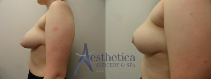 Breast Lift Case 346 Before & After View #3 | Columbus, OH | Aesthetica Surgery & Spa