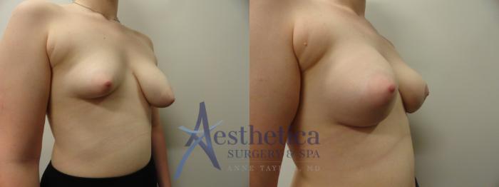 Breast Lift Case 346 Before & After View #4 | Columbus, OH | Aesthetica Surgery & Spa