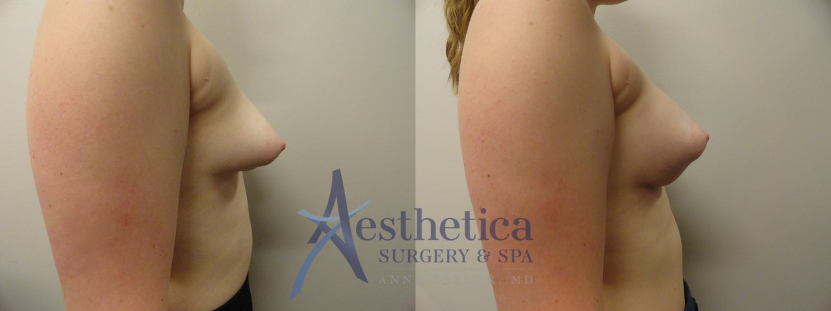 Breast Lift Case 346 Before & After View #5 | Columbus, OH | Aesthetica Surgery & Spa