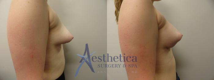 Breast Lift Case 346 Before & After View #5 | Columbus, OH | Aesthetica Surgery & Spa