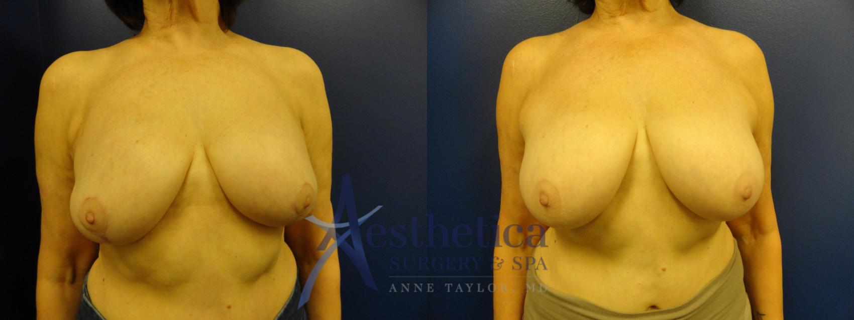 Breast Lift Case 347 Before & After View #1 | Worthington, OH | Aesthetica Surgery & Spa