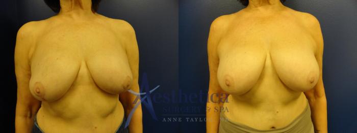 Breast Lift Case 347 Before & After View #1 | Columbus, OH | Aesthetica Surgery & Spa