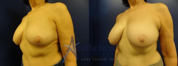 Breast Lift Case 347 Before & After View #2 | Columbus, OH | Aesthetica Surgery & Spa