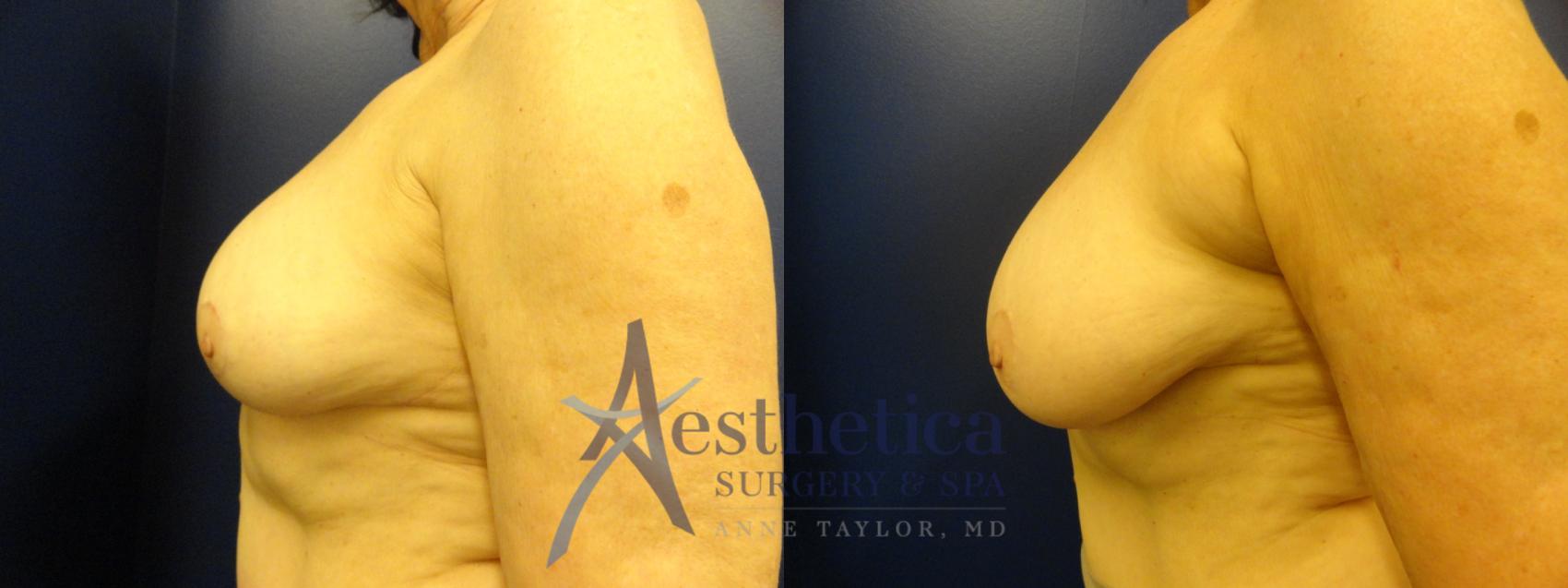 Breast Lift Case 347 Before & After View #3 | Worthington, OH | Aesthetica Surgery & Spa