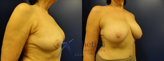 Breast Lift Case 347 Before & After View #4 | Columbus, OH | Aesthetica Surgery & Spa