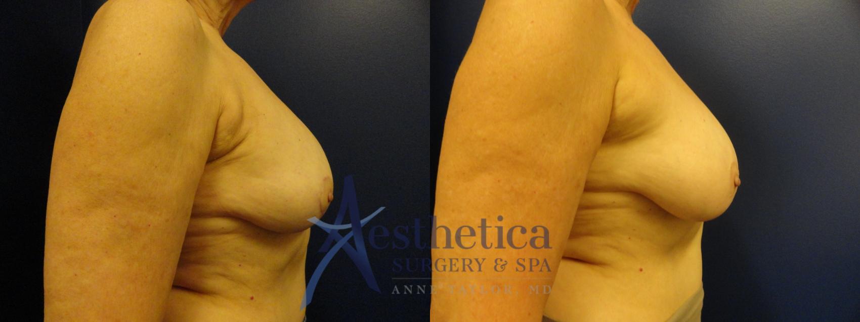 Breast Lift Case 347 Before & After View #5 | Worthington, OH | Aesthetica Surgery & Spa
