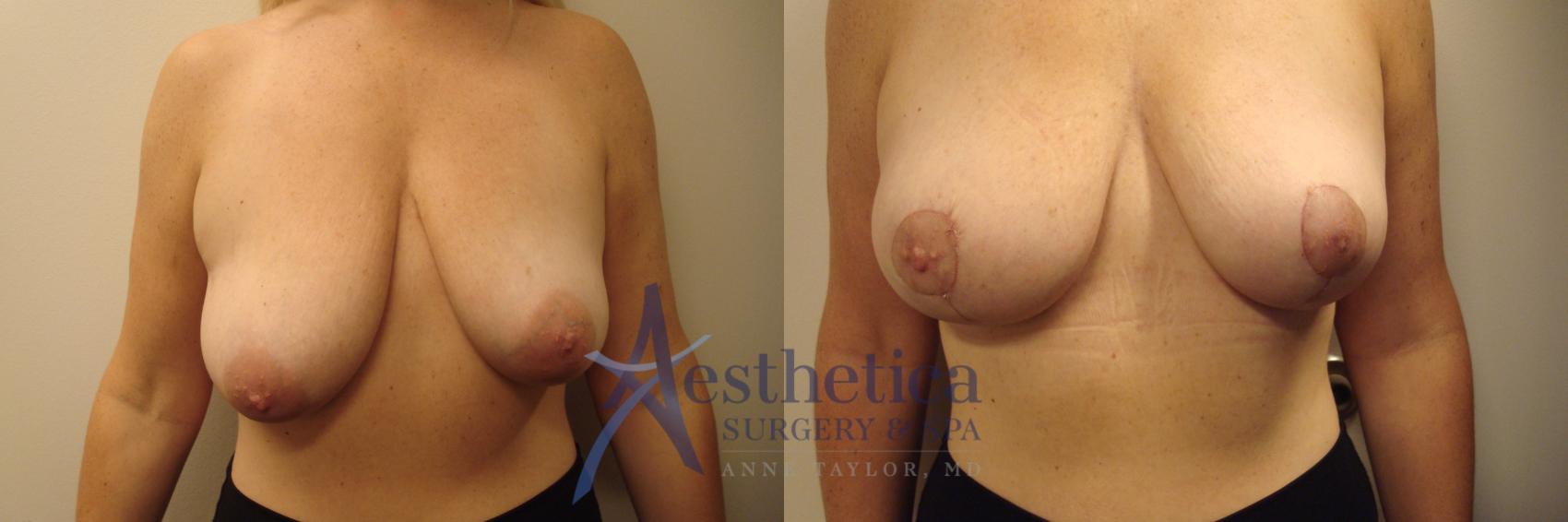 Breast Lift Case 358 Before & After View #1 | Columbus, OH | Aesthetica Surgery & Spa