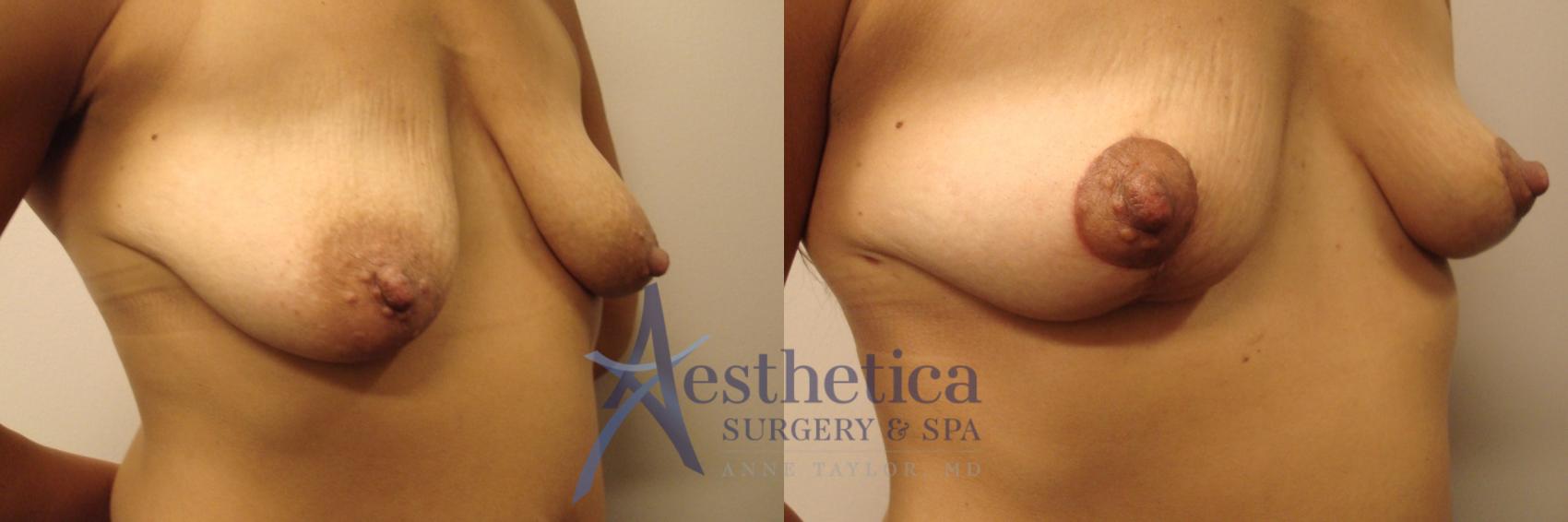 Breast Lift Case 442 Before & After Right Oblique | Worthington, OH | Aesthetica Surgery & Spa