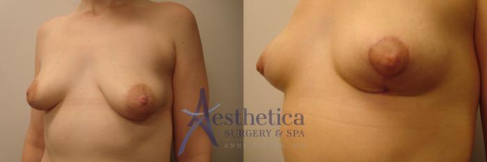 Breast Lift Case 447 Before & After Left Oblique | Columbus, OH | Aesthetica Surgery & Spa