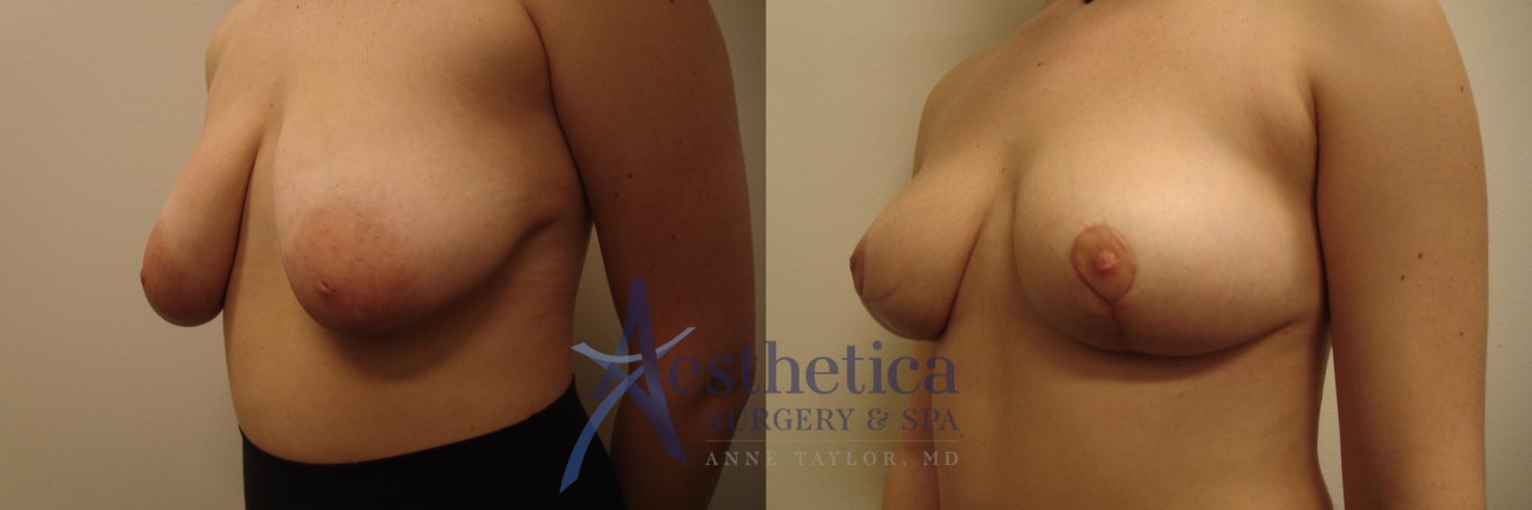 Breast Lift Case 467 Before & After Left Oblique | Worthington, OH | Aesthetica Surgery & Spa