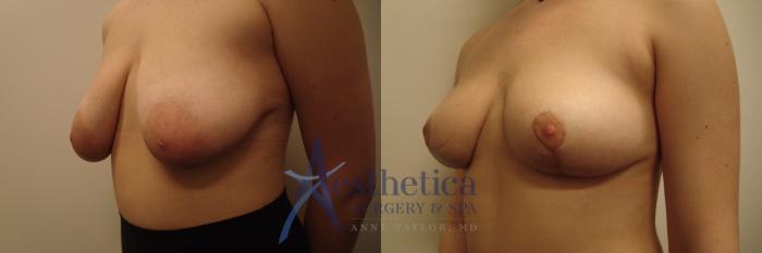 Breast Lift Case 467 Before & After Left Oblique | Columbus, OH | Aesthetica Surgery & Spa