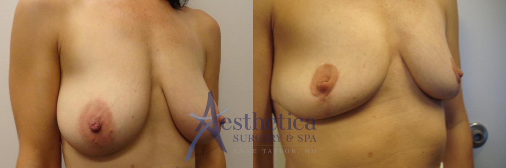 Breast Lift Case 481 Before & After Right Oblique | Worthington, OH | Aesthetica Surgery & Spa