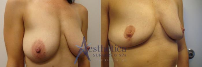Breast Lift Case 481 Before & After Right Oblique | Columbus, OH | Aesthetica Surgery & Spa