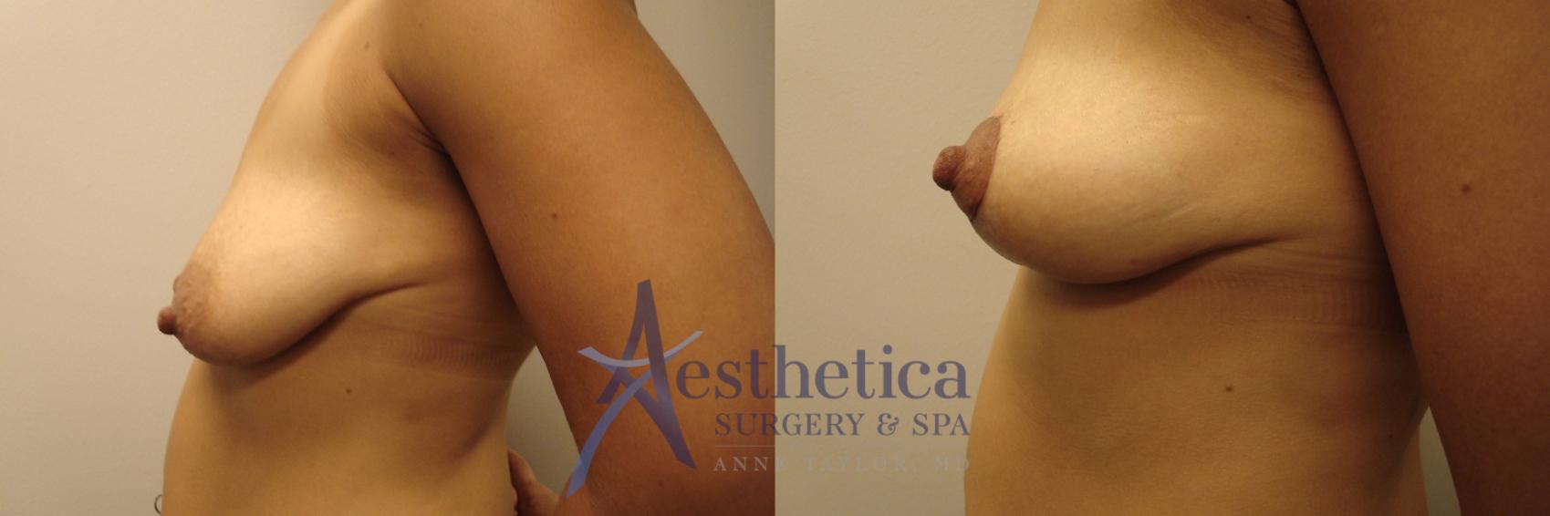Breast Lift Case 505 Before & After Left Side | Worthington, OH | Aesthetica Surgery & Spa