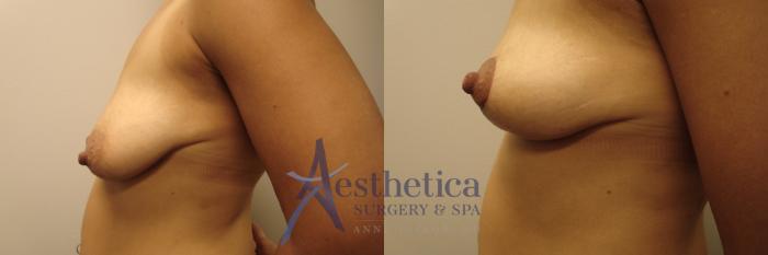 Breast Lift Case 505 Before & After Left Side | Columbus, OH | Aesthetica Surgery & Spa