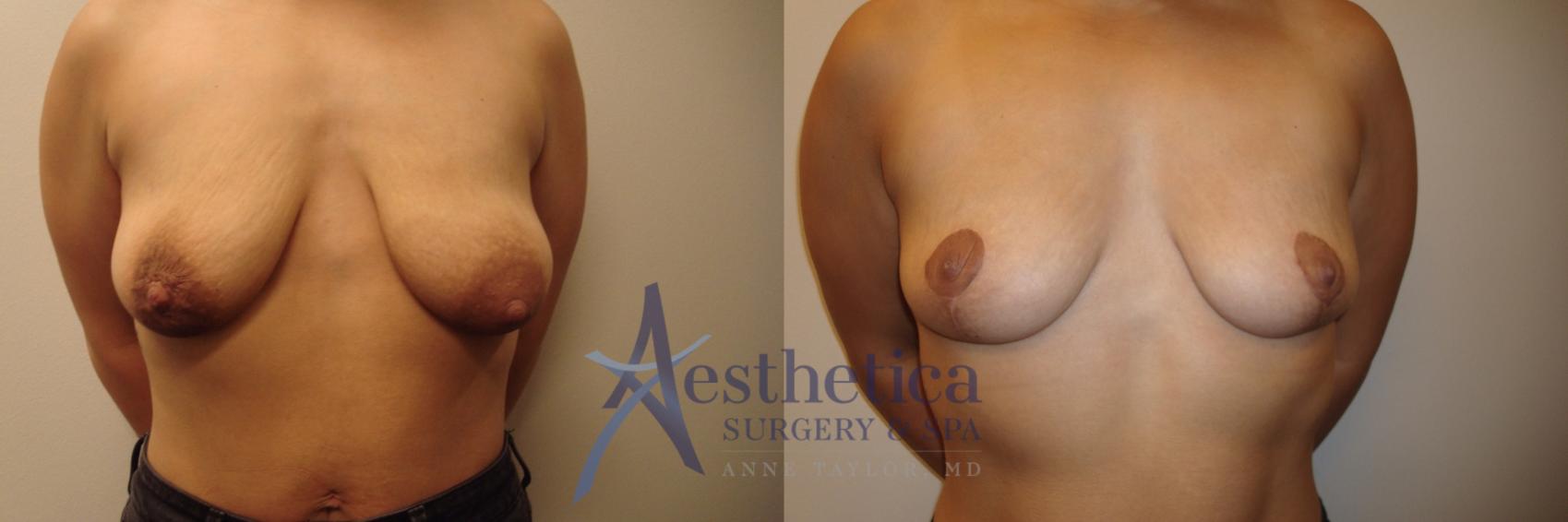 Breast Lift Case 522 Before & After Front | Worthington, OH | Aesthetica Surgery & Spa