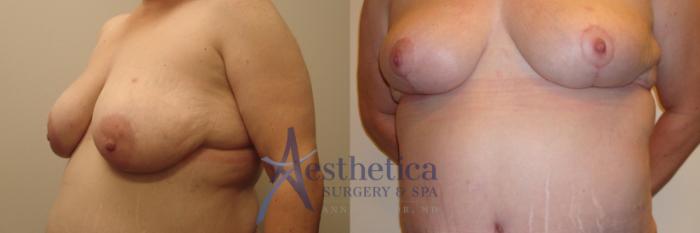 Breast Lift Case 536 Before & After Front | Columbus, OH | Aesthetica Surgery & Spa