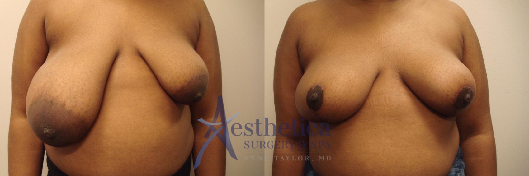 Breast Lift Case 568 Before & After Front | Worthington, OH | Aesthetica Surgery & Spa