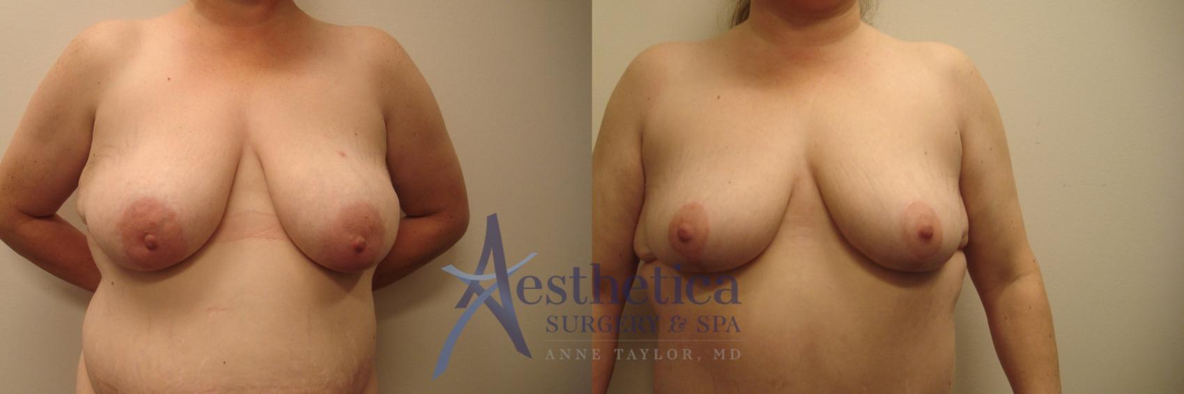 Breast Lift Case 580 Before & After Front | Columbus, OH | Aesthetica Surgery & Spa