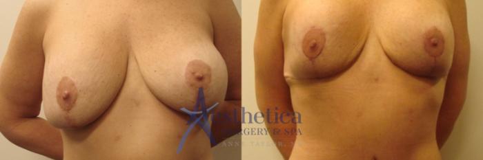 Breast Lift Case 590 Before & After Front | Columbus, OH | Aesthetica Surgery & Spa