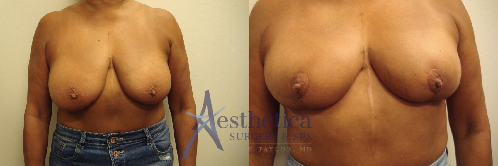 Breast Lift Case 652 Before & After Front | Columbus, OH | Aesthetica Surgery & Spa