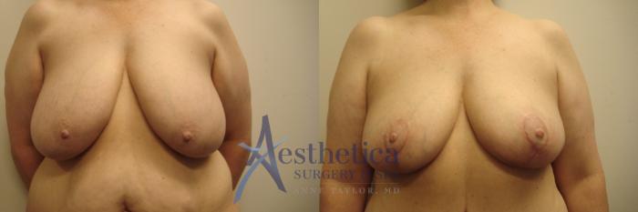 Breast Lift Case 682 Before & After Front | Columbus, OH | Aesthetica Surgery & Spa