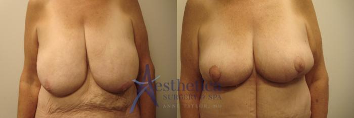 Breast Lift Case 752 Before & After Front | Columbus, OH | Aesthetica Surgery & Spa