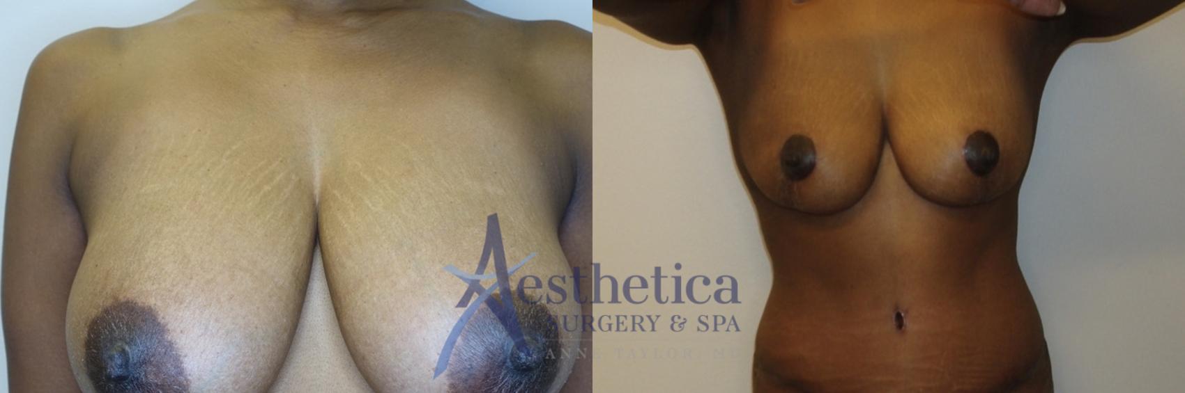 Breast Lift Case 766 Before & After Front | Columbus, OH | Aesthetica Surgery & Spa