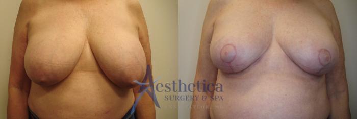 Breast Lift Case 778 Before & After Front | Columbus, OH | Aesthetica Surgery & Spa