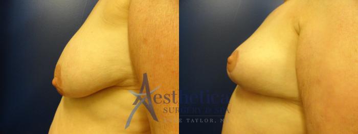 Breast Lift Case 78 Before & After View #1 | Columbus, OH | Aesthetica Surgery & Spa