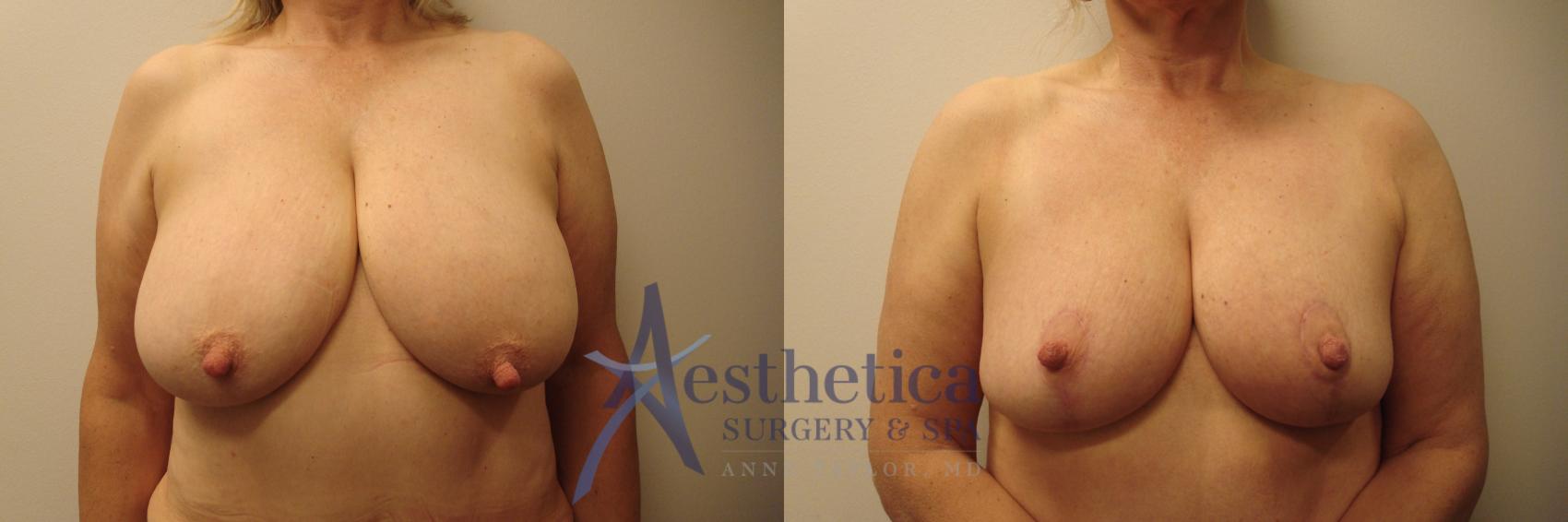 Breast Lift Case 790 Before & After Front | Columbus, OH | Aesthetica Surgery & Spa