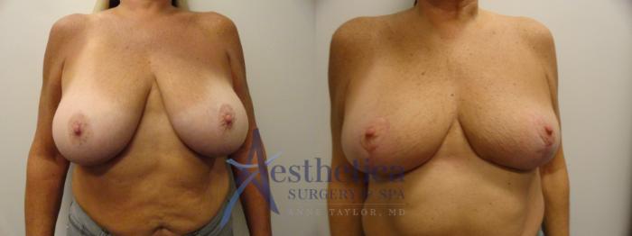 Breast Lift Case 830 Before & After Front | Columbus, OH | Aesthetica Surgery & Spa