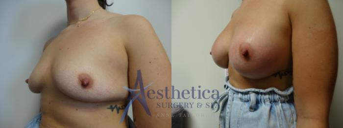 Breast Lift Case 893 Before & After Front | Columbus, OH | Aesthetica Surgery & Spa