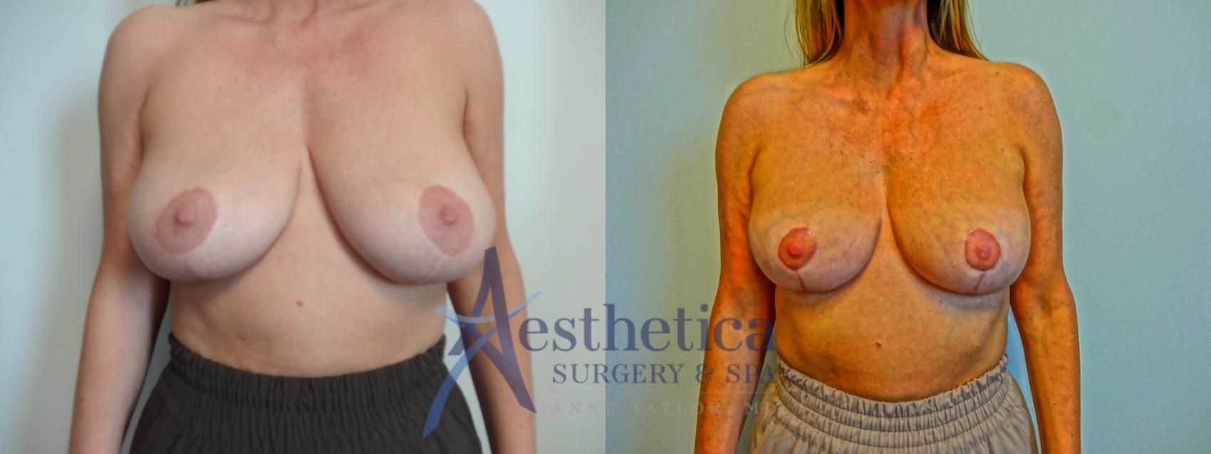 Breast Lift Case 901 Before & After Front | Columbus, OH | Aesthetica Surgery & Spa