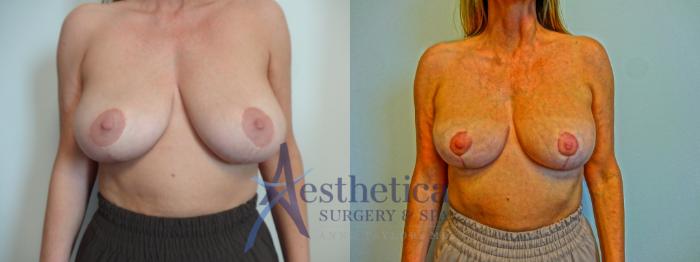 Breast Lift Case 901 Before & After Front | Columbus, OH | Aesthetica Surgery & Spa