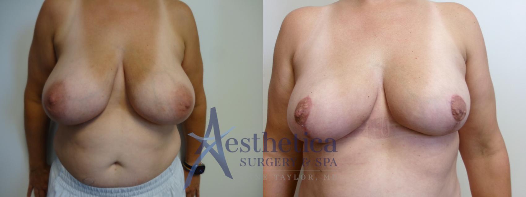 Breast Lift Case 907 Before & After Front | Columbus, OH | Aesthetica Surgery & Spa