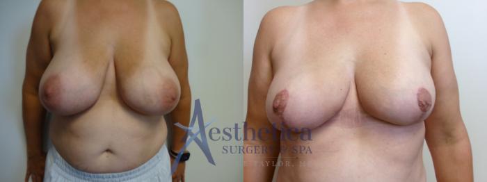 Breast Lift Case 907 Before & After Front | Columbus, OH | Aesthetica Surgery & Spa
