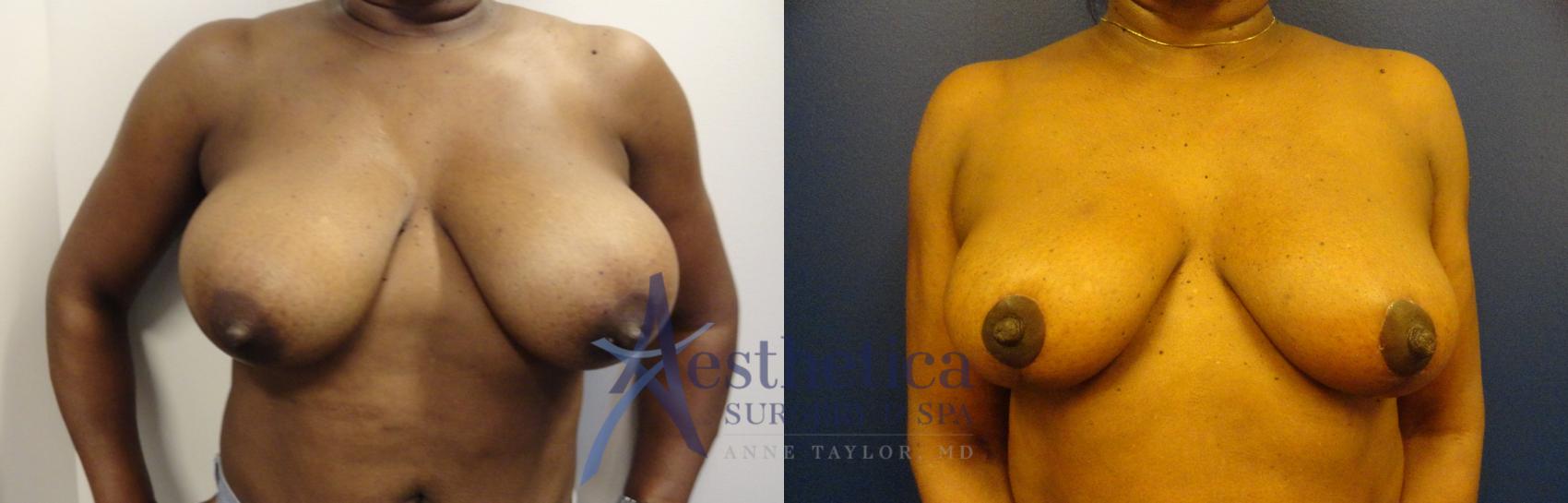 Breast Reduction Case 102 Before & After View #1 | Columbus, OH | Aesthetica Surgery & Spa