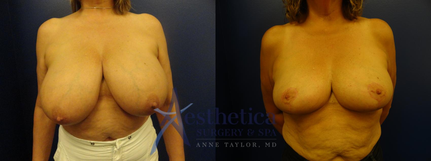 Breast Reduction Case 103 Before & After View #1 | Columbus, OH | Aesthetica Surgery & Spa